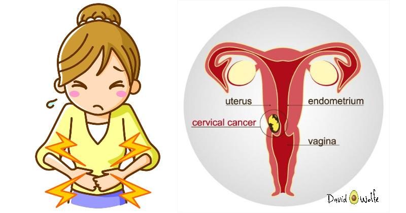 The best way to treat cervical cancer tumors- chemo-radiotherapy