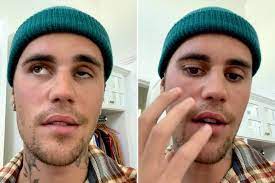 Justin Bieber Half Face Paralyzed After Virus Attack Instagram Video Goes Viral World Tour 2022 Postponed